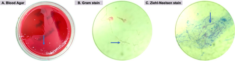 A complex case of Nocardia keratitis: challenges in diagnosis and therapy.
