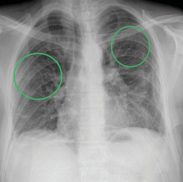 Birt-Hogg-Dubé syndrome: A case series highlighting pulmonary manifestations, rare renal involvement and role of familial diagnosis.