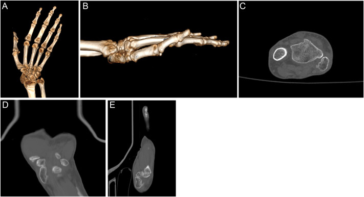 A rare case of an isolated scaphoid dislocation neglected for 45 years: A case report and literature review.
