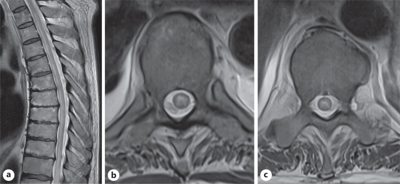 Seronegative Autoimmune Encephalomyelitis with Area Postrema Symptoms.