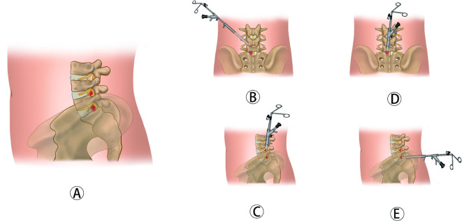 Clinical comparison of percutaneous endoscopic lumbar discectomy and posterior lumbar interbody fusion for L4/5 and L5/S1 dual-level disc herniation.
