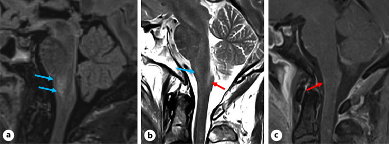 Seronegative Autoimmune Encephalomyelitis with Area Postrema Symptoms.