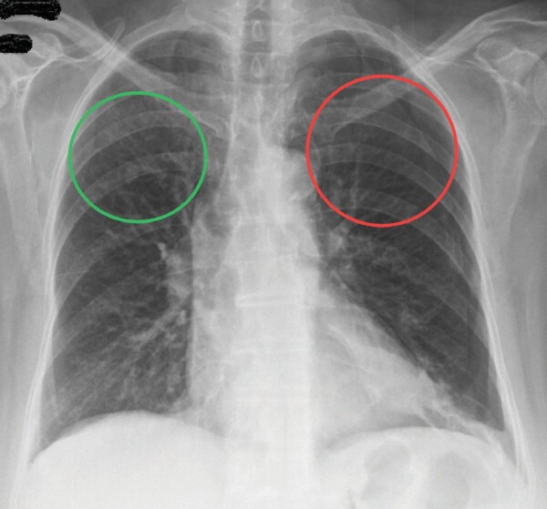 Birt-Hogg-Dubé syndrome: A case series highlighting pulmonary manifestations, rare renal involvement and role of familial diagnosis.
