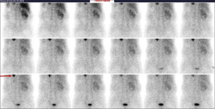 Intrathoracic Kidney Detected on DTPA Scan.