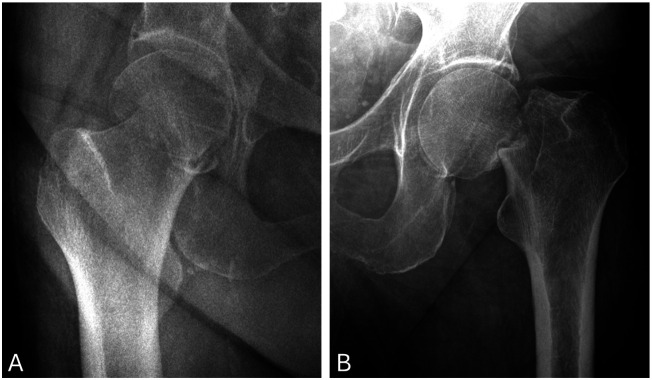 Routine histopathological examination of femoral heads and incidental metastatic bone disease in hip arthroplasty.