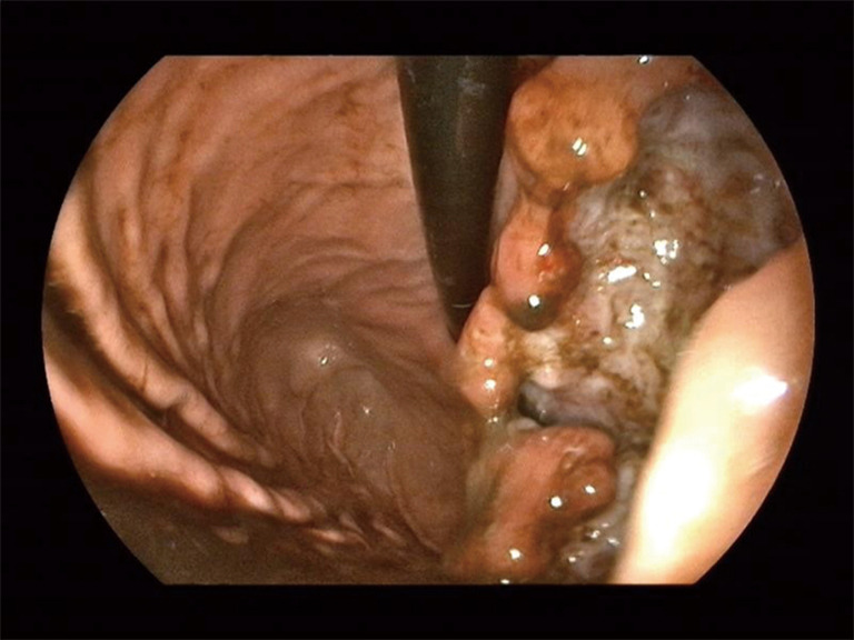 Isolated gastric metastasis of endometrioid carcinoma: a case report and literature review.