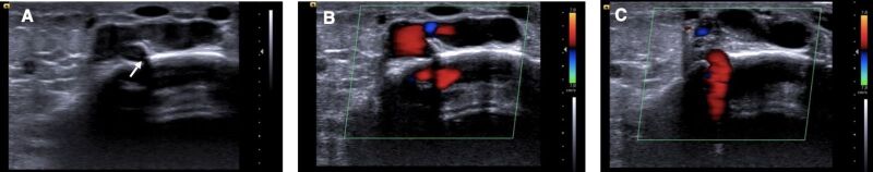 Anomalous intraosseous venous drainage of pretibial varices: case report.