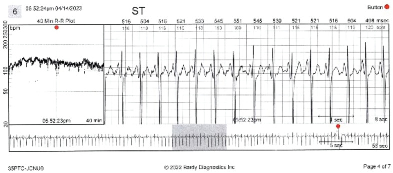 Non-invasive Vagus Nerve Stimulation as an Adjunct Treatment for Inappropriate Sinus Tachycardia.