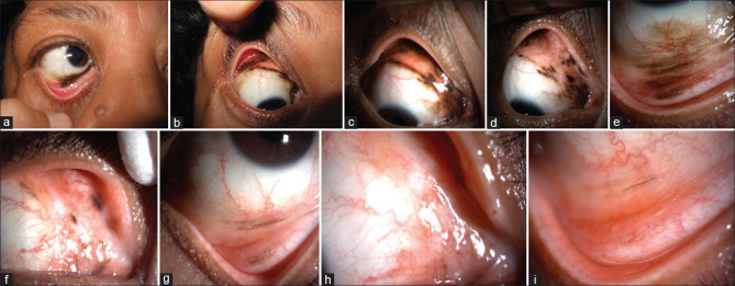 Immune check point inhibitors for ocular adnexal and periocular tumors.