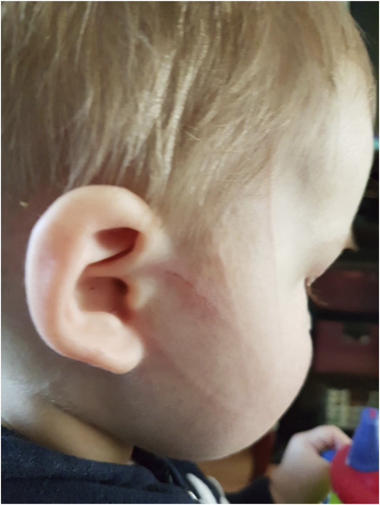<i>Bartonella henselae</i>, <i>Babesia odocoilei</i> and <i>Babesia divergens</i>-like MO-1 infection in the brain of a child with seizures, mycotoxin exposure and suspected Rasmussen's encephalitis.