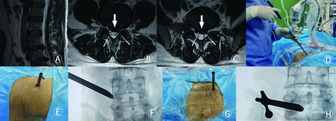 Clinical comparison of percutaneous endoscopic lumbar discectomy and posterior lumbar interbody fusion for L4/5 and L5/S1 dual-level disc herniation.