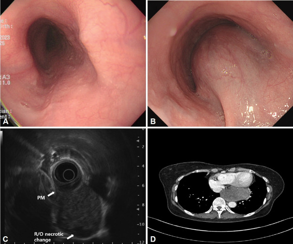 Rapidly Growing Gastrointestinal Stromal Tumor on the Esophagus.