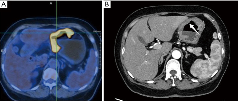 Isolated gastric metastasis of endometrioid carcinoma: a case report and literature review.