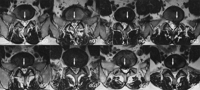 Clinical comparison of percutaneous endoscopic lumbar discectomy and posterior lumbar interbody fusion for L4/5 and L5/S1 dual-level disc herniation.
