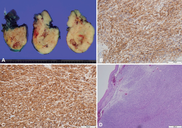 Rapidly Growing Gastrointestinal Stromal Tumor on the Esophagus.