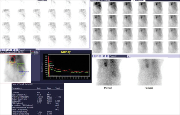 Intrathoracic Kidney Detected on DTPA Scan.