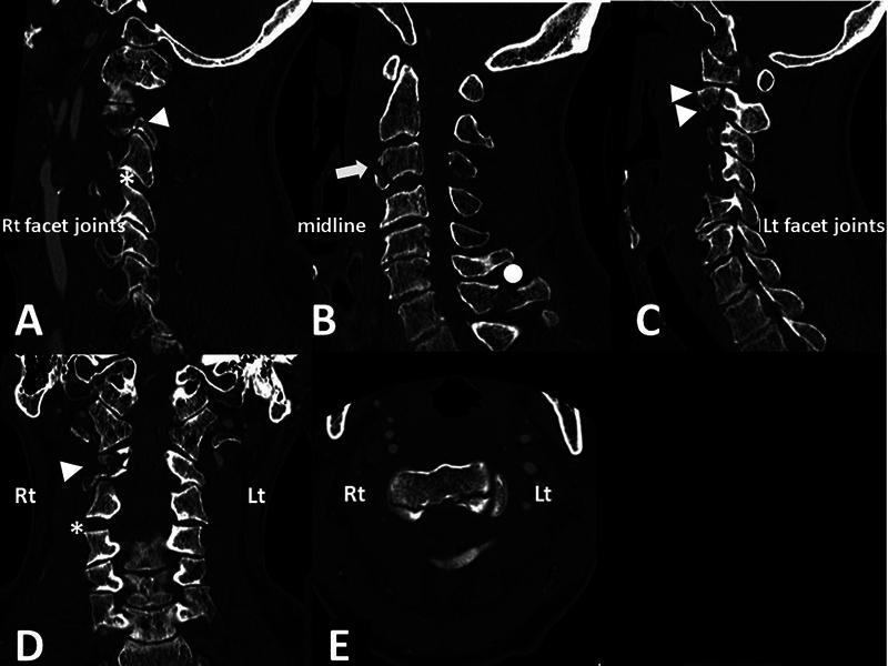 Unstable Upper Cervical Spine Injury with Concomitant Bilateral Ponticulus Posticus: A Case Report.