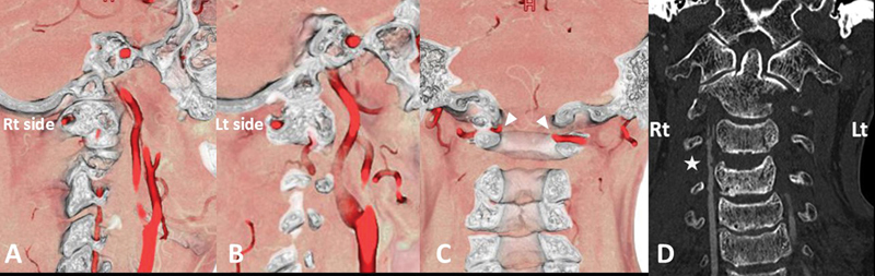 Unstable Upper Cervical Spine Injury with Concomitant Bilateral Ponticulus Posticus: A Case Report.