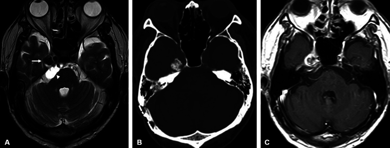 Recurrent Calcifying Pseudoneoplasm of the Neuraxis in Meckel's Cave with Cyst Extending into the Cerebellopontine Cistern after Resection of the Cystic Component: A Case Report.
