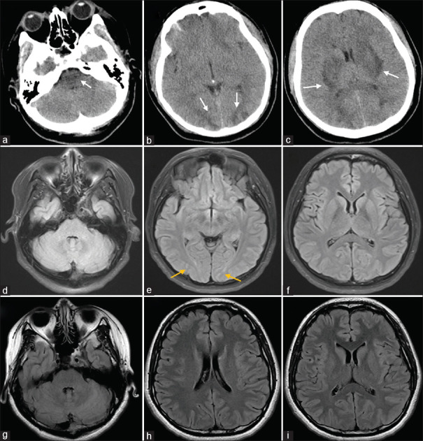 The evolving imaging of rapidly improving posterior reversible encephalopathy syndrome: A case report.