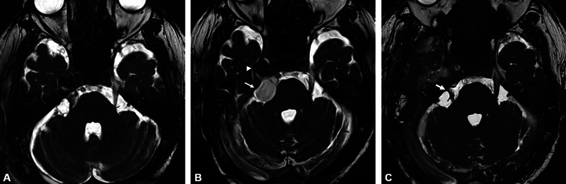 Recurrent Calcifying Pseudoneoplasm of the Neuraxis in Meckel's Cave with Cyst Extending into the Cerebellopontine Cistern after Resection of the Cystic Component: A Case Report.
