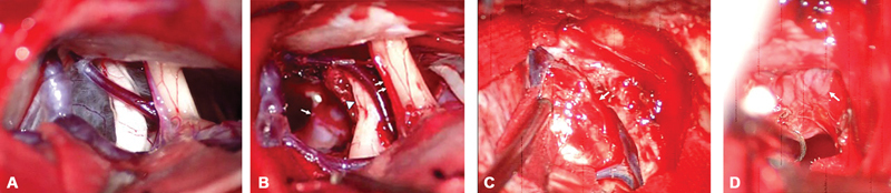 Recurrent Calcifying Pseudoneoplasm of the Neuraxis in Meckel's Cave with Cyst Extending into the Cerebellopontine Cistern after Resection of the Cystic Component: A Case Report.