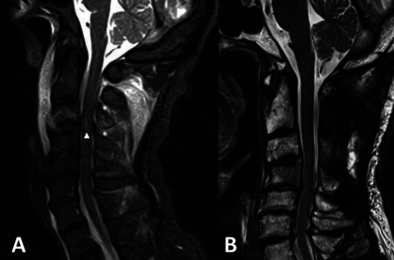 Unstable Upper Cervical Spine Injury with Concomitant Bilateral Ponticulus Posticus: A Case Report.