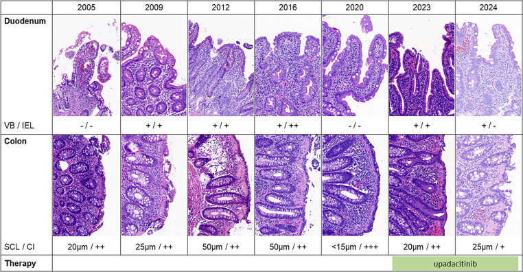 First Description of Upadacitinib as Treatment for Collagenous Colitis with a Concomitant Lymphocytic Disorder of the Upper Gastrointestinal Tract.