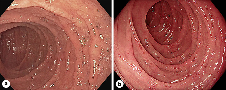 First Description of Upadacitinib as Treatment for Collagenous Colitis with a Concomitant Lymphocytic Disorder of the Upper Gastrointestinal Tract.