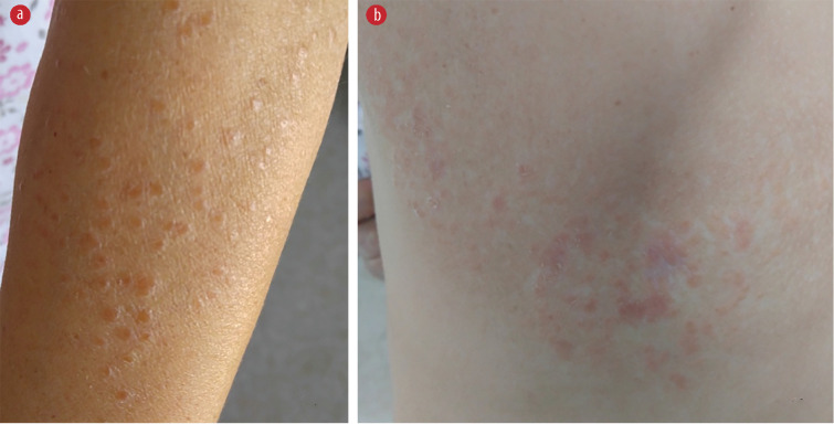 Prolonged Fever and Severe Hypercalcemia Revealing Systemic Extrapulmonary Sarcoidosis: A Lesson to be Learned.