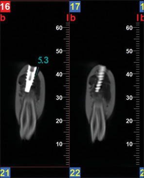 Comparative evaluation of ultrasonography with cone-beam computed tomography for peri-implant bone loss analysis - A cadaveric goat mandible study.