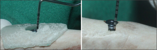 Comparative evaluation of ultrasonography with cone-beam computed tomography for peri-implant bone loss analysis - A cadaveric goat mandible study.