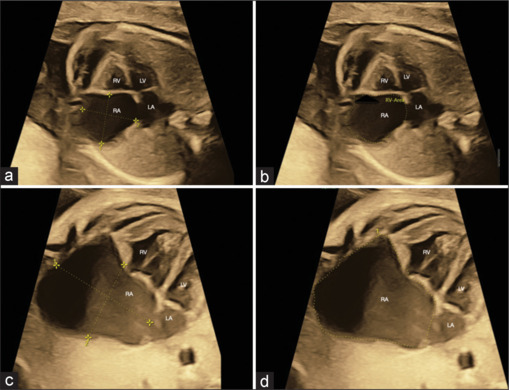 Prenatally diagnosed congenital right atrial aneurysm using three/four-dimensional spatiotemporal image correlation fetal echocardiography.