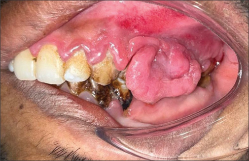 Intraoral capillary hemangioma in Sturge-Weber syndrome - A rare case report and its periodontal management.