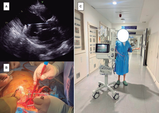 High capacity Impella, an effective mechanical support strategy for patients in cardiogenic shock bridged to heart transplantation.