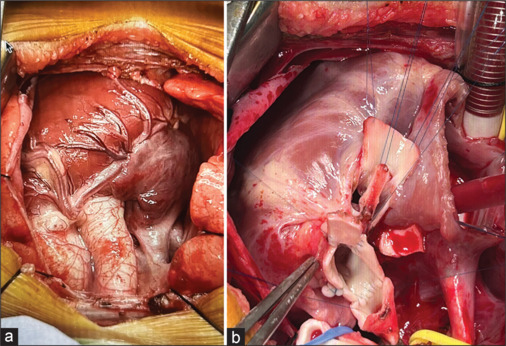 Transposition of the great arteries with posterior aorta: A rare entity.