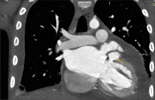 Myocardial abscess from <i>Stenotrophomonas maltophilia</i> endocarditis in an adolescent.