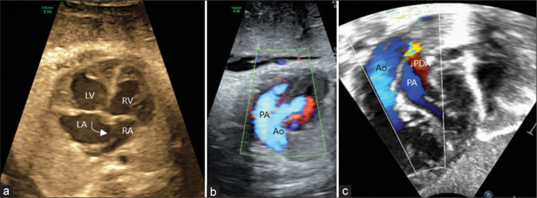 Forewarned is forearmed: The critical role of prenatal diagnosis in managing high-risk neonates with transposition of great arteries-intact ventricular septum.
