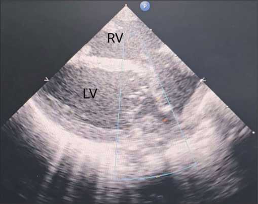 Huge cardiac rhabdomyoma in a neonate: A surgical challenge.