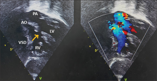 Transposition of the great arteries with posterior aorta: A rare entity.