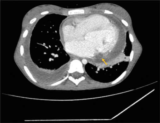 Myocardial abscess from <i>Stenotrophomonas maltophilia</i> endocarditis in an adolescent.