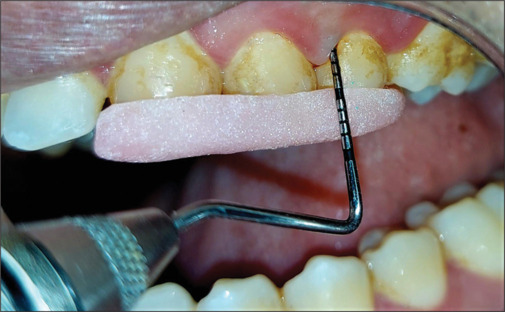 Chairside clinicomicrobiological assessment of subgingival boric acid irrigation in periodontitis patients: A randomized controlled trial.