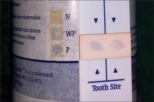 Chairside clinicomicrobiological assessment of subgingival boric acid irrigation in periodontitis patients: A randomized controlled trial.