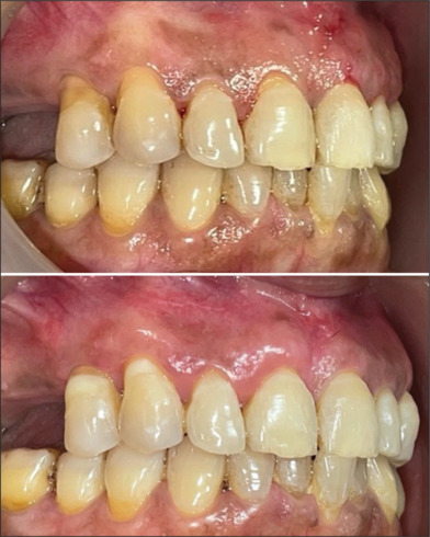 Comparative evaluation of vestibular incision subperiosteal tunnel access and coronally advanced flap in adjunction with platelet-rich fibrin for maxillary gingival recession - A randomized controlled study.