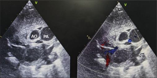 Transposition of the great arteries with posterior aorta: A rare entity.