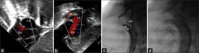 Forewarned is forearmed: The critical role of prenatal diagnosis in managing high-risk neonates with transposition of great arteries-intact ventricular septum.