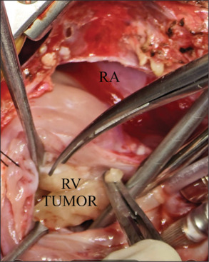 Huge cardiac rhabdomyoma in a neonate: A surgical challenge.