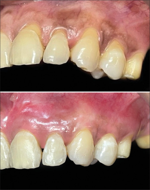 Comparative evaluation of vestibular incision subperiosteal tunnel access and coronally advanced flap in adjunction with platelet-rich fibrin for maxillary gingival recession - A randomized controlled study.