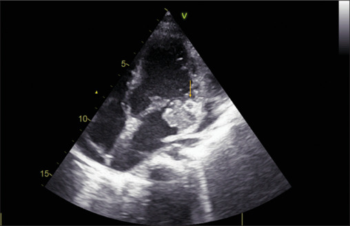 Myocardial abscess from <i>Stenotrophomonas maltophilia</i> endocarditis in an adolescent.