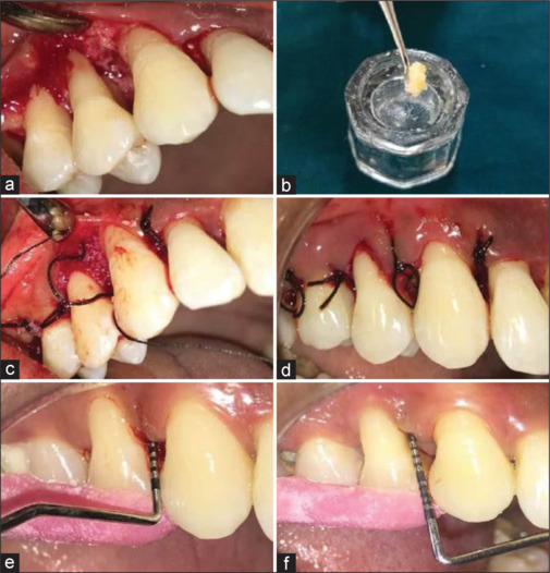 Clinical evaluation of injectable platelet-rich fibrin with synthetic nanocrystalline hydroxyapatite bone graft for the treatment of intrabony defects: A randomized controlled clinical trial.